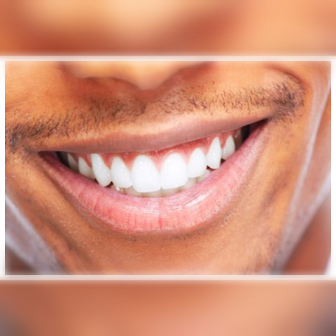 Clareador Dental: O que você deve saber antes de usar as fitas de clareamento dental